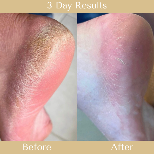 Before & After results from Bees Knees Head over Heels Cracked Heel & Foot Treatment repair